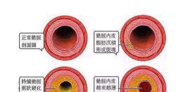 血栓可以吃兰花豆吗有效果吗