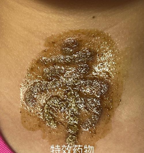 植物纹身的去除方法有哪些？哪种方式最有效？